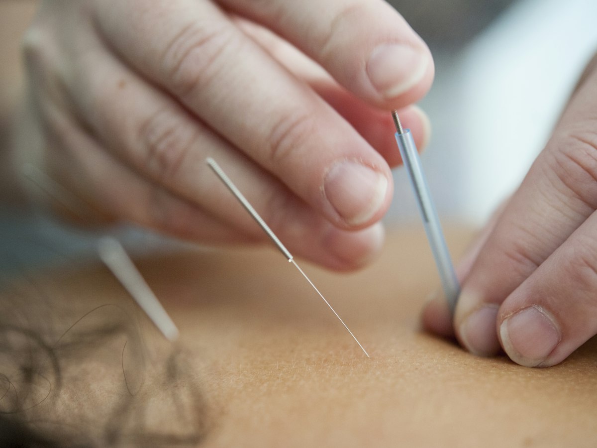 A physician placing fine acupuncture needles